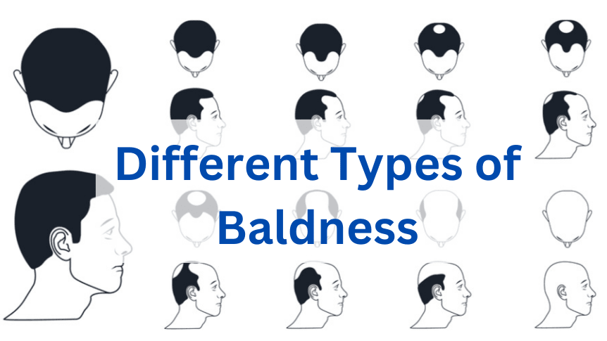 The Different Types of Baldness: Understanding Causes and Solutions for Hair Loss